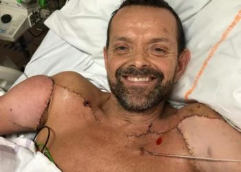 Félix Gretarsson, recibió trasplante de ambos brazos.