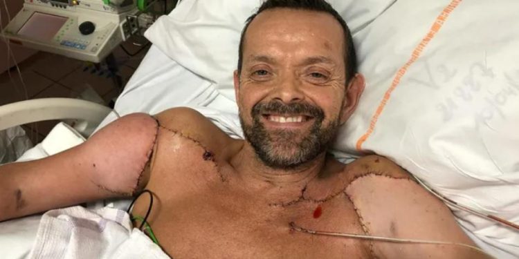 Primer hombre con doble trasplante de brazo ha evolucionado satisfactoriamente 1 Félix Gretarsson, recibió trasplante de ambos brazos.