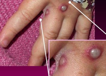 Madrid confirma siete casos de viruela del mono y alerta sobre 22 como sospechosos