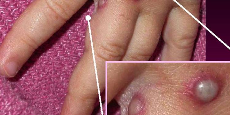 Madrid confirma siete casos de viruela del mono y alerta sobre 22 como sospechosos