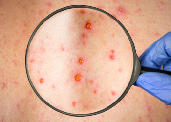 OMS viruela del mono tiene altas probabilidades de propagación en el futuro