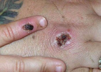 Conoce los riesgos de una enfermedad que está causando incógnitas