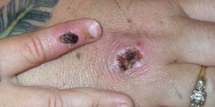 Viruela del mono: ¿Cómo se contagia y cuáles son sus síntomas? 1 Conoce los riesgos de una enfermedad que está causando incógnitas