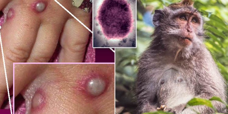 EE.UU. detectó los primeros dos casos de la viruela del mono en niños 1 Captura de pantalla de 2022 07 25 11 08 34