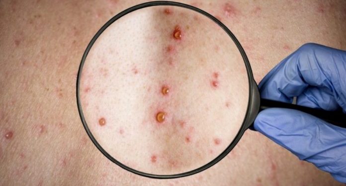 La viruela del mono no constituye una emergencia de salud pública de escala internacional.