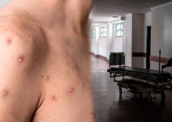 Autoridades brasileñas confirman primera muerte por viruela del mono