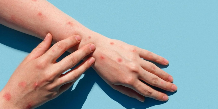 Confirman dos nuevos casos de viruela del mono en Venezuela 1 image 237