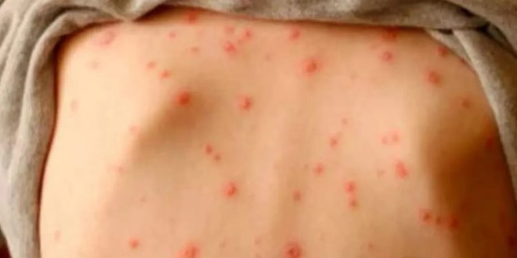 157 menores muertos tras brote de sarampión en Zimbabue 1 Autoridades de salud realizarán una jornada de vacuna masiva antes de comenzar las clases en el mes de septiembre