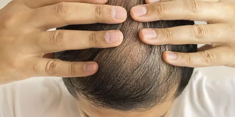 ¿Cómo frenar la caída del cabello con remedios caseros? 1 calvicie